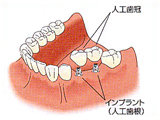 インプラント