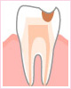 C2　象牙質の入れ歯