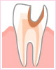 C3　神経の虫歯
